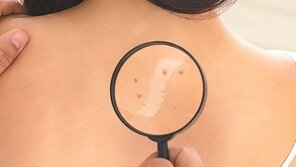 여드름인줄 알았는데… 온몸에 번지는 ‘화농성 한선염’