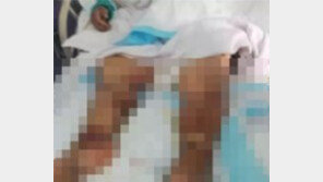 새우 꼬리에 손가락 찔린 주부 2일 만에 사망…어찌된 일?