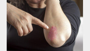 중증건선 산정특례 적용 1년…의료비 부담 60% →10% 크게 감소