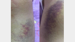 이석철·승현, 소속사 PD·김창환 회장 고소…맞아 피멍 든 사진도 공개