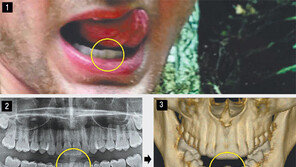 “웜비어 치아, 물리적 충격에 변형… 北서 고문 가능성”