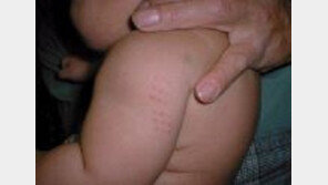 BCG 경피용 백신서 기준치 이상 비소 검출…비소? 선과 악 공존 