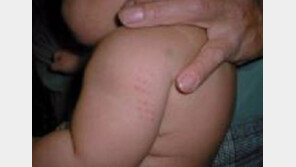 “핏덩이에 독극물, 끔찍”…BCG 경피용 백신 비소 검출에 靑 청원 150건↑