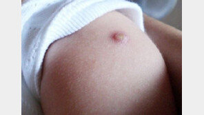 비소 초과 검출 BCG 경피용 백신 회수…대안은 ‘불주사’ 뿐?   