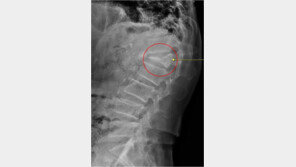 50대 넘어 첫 고관절 골절 환자, 17.4% 1년 이내 사망…고령자 치명적