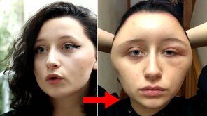 염색하려다…19세 여, 얼굴 두배 팽창 “숨 못 쉬어 죽을 뻔”