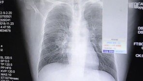 “더러운 양말냄새 맡으면 폐질환 발병”…중국남성 사례 보도