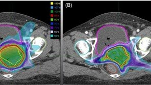 자궁경부암세포 골라 죽이는 방사선 치료 ‘5년 생존율 66%’
