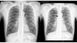 서울대병원, 인공지능으로 ‘폐암 진단’ 정확도↑