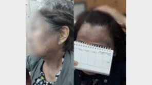 헤나 염색 부작용, 피부 검게 변한 사람들 “지옥의 가루…죽고 싶다” 