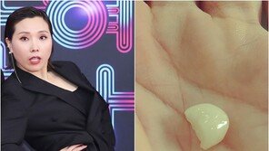 신봉선 “열일했어”…부러진 어금니에 안타까움