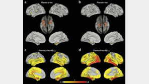 혈액 한 방울로 치매 진행 정도 예측한다