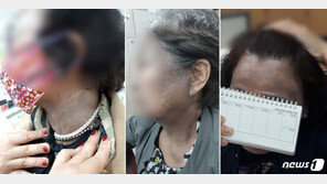 ‘헤나’ 부작용  ‘흑피증’ 잇따라…인천시, 집중 단속