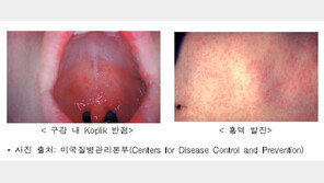 홍역 증상, 기침·콧물·결막염→고열·발진…“환자 접촉 시 90% 이상 감염”