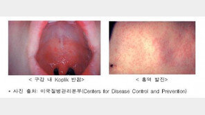 26일 오전 10시 기준, 홍역 확진자 38명…32명 ‘격리 해제’