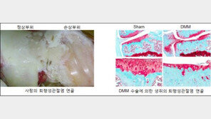 “퇴행성관절염 원인은 콜레스테롤”…韓연구팀 세계 최초 증명