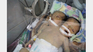 ‘생사기로’ 예멘 샴쌍둥이, 해외 수술 대기 중 안타깝게 숨져