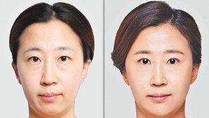 절개 없이 20분 만에 ‘동안 눈매’ 만든다
