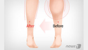 “날씬한 종아리 만들려다”…퇴축술 부작용에 절뚝걸음