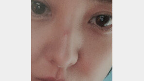 [내가 왜 떴게?] 부어도 예쁜 당신…박은혜, 코뼈 부상