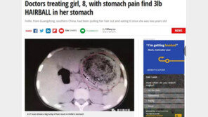 8세 소녀 배 속에서 ‘1.5kg’ 머리털 뭉치가…두 살 때부터 먹었다고?
