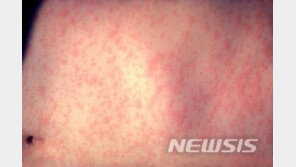 안양지역 홍역 1명 추가 확진…병문안 왔던 일반인