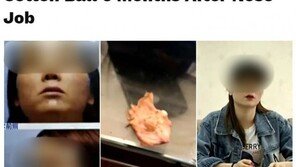 재채기했는데 코에서 솜뭉치가?…‘코 성형’ 女, 병원에 손해배상 청구