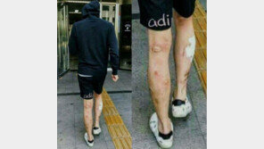 박유천 다리 상처  ‘메스버그 현상’ ?… 심증 뿐, 단정 못 해