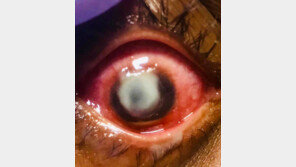 눈에 고름 가득… 콘택트렌즈 끼고 잔 결과 ‘참담’