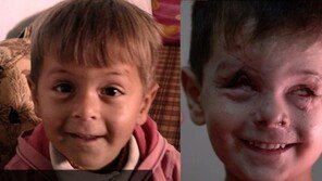 몸에서 유리조각 나오는 아이…시리아의 비극