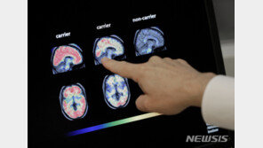 알츠하이머, 빛과 소리로 치료한다…美연구팀, 임상실험 시작