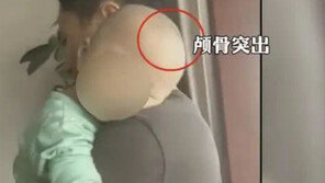 [월드톡]中서 가짜분유 먹은 아이들 두개골 부풀어…부작용 속출