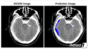 AI로 수초 안에 뇌출혈 분석…“골든타임 사수”