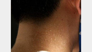 땀 악취증 환자, ‘30대 이하’ 74% 압도적…예방법은?