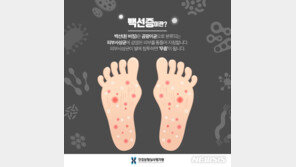 여름철 무좀 환자 급증…백선증 주의보