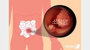 속 불편하고 구토 체중도 뚝뚝…생소한 소장암 뭐길래