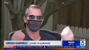 ‘무서운 코로나’ 美 남성, 혈액응고로 손가락 모두 절단