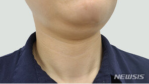 다이어트 해도 살 안빠지면 쿠싱증후군 의심봐해야