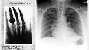 125년전 결핵 잡았던 X선, 이번엔 코로나19 잡는다