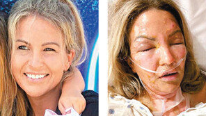 손세정제 바른뒤 촛불 켜다 전신 화상 