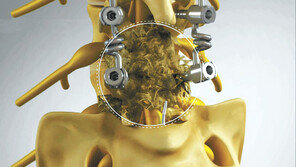 원인 알 수 없는 허리 통증… 추간공확장술로 미세 유착 찾아 치료