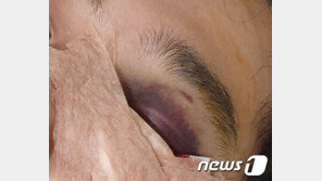 “예비신랑 맞은거 보세요” 층간소음 항의에 집단폭행 당한 부부