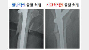 골다공증약 오래 복용하면 골절 부르기도