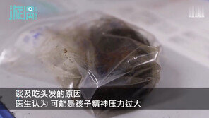 中 10살 아이, 배 아파 병원갔더니…1.5kg 머리카락 뭉치 나와