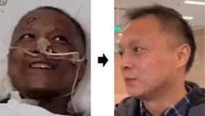 코로나로 얼굴 새까매진 中의사 “이젠 괜찮아요”