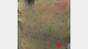 가볍게 여겼다간 ‘큰코’…우울증·자살 부르는 피부병