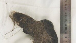 “배 아파” 병원 간 12세 소녀 배 속에 들어있던 것은…