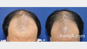 보톡스가 탈모 치료제로… 대웅제약 나보타, 남성 탈모 증상 개선 효과 입증