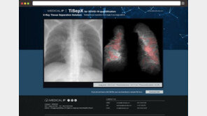 국내 벤처, 엑스레이로 1분만에 코로나19 환자 판별 기술 선보여