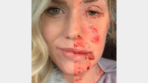 18년 간 피부병으로 고생한 여성…‘이것’ 끊으니 기적같은 일이